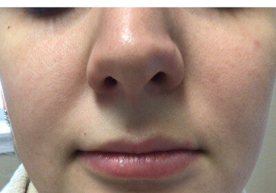 Fillers