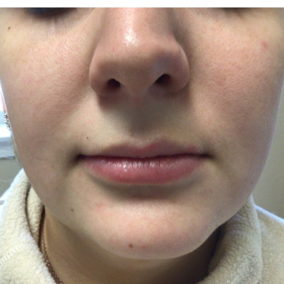 Fillers